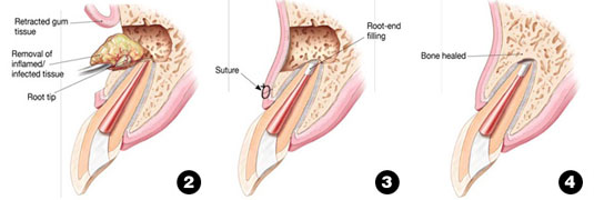 surgery procedure 2 through 4