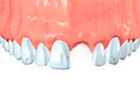 Avulsed Teeth