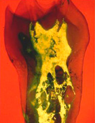 Root Canal X-Ray