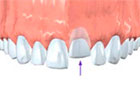Dislodged Teeth