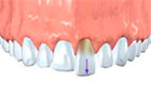 Pushed Out Teeth
