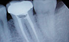 Root Canal X-Ray